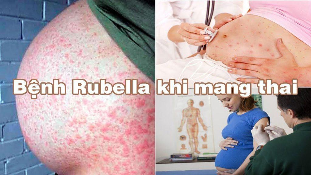 rubella-khi-mang-thai-nhung-bien-chung-nguy-hiem-me-can-biet-01