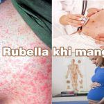 rubella-khi-mang-thai-nhung-bien-chung-nguy-hiem-me-can-biet-01