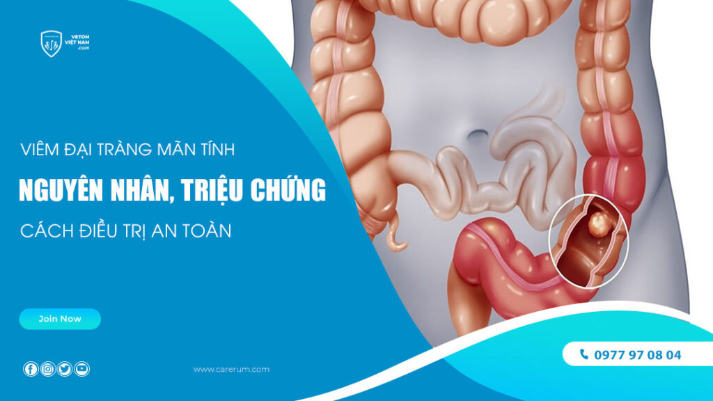 Viêm đại tràng mãn tính: Nguyên nhân, triệu chứng và cách điều trị an toàn